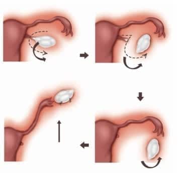 Imagem ilustrativa do processo de transposição ovariana, que protege os ovários da radioterapia.